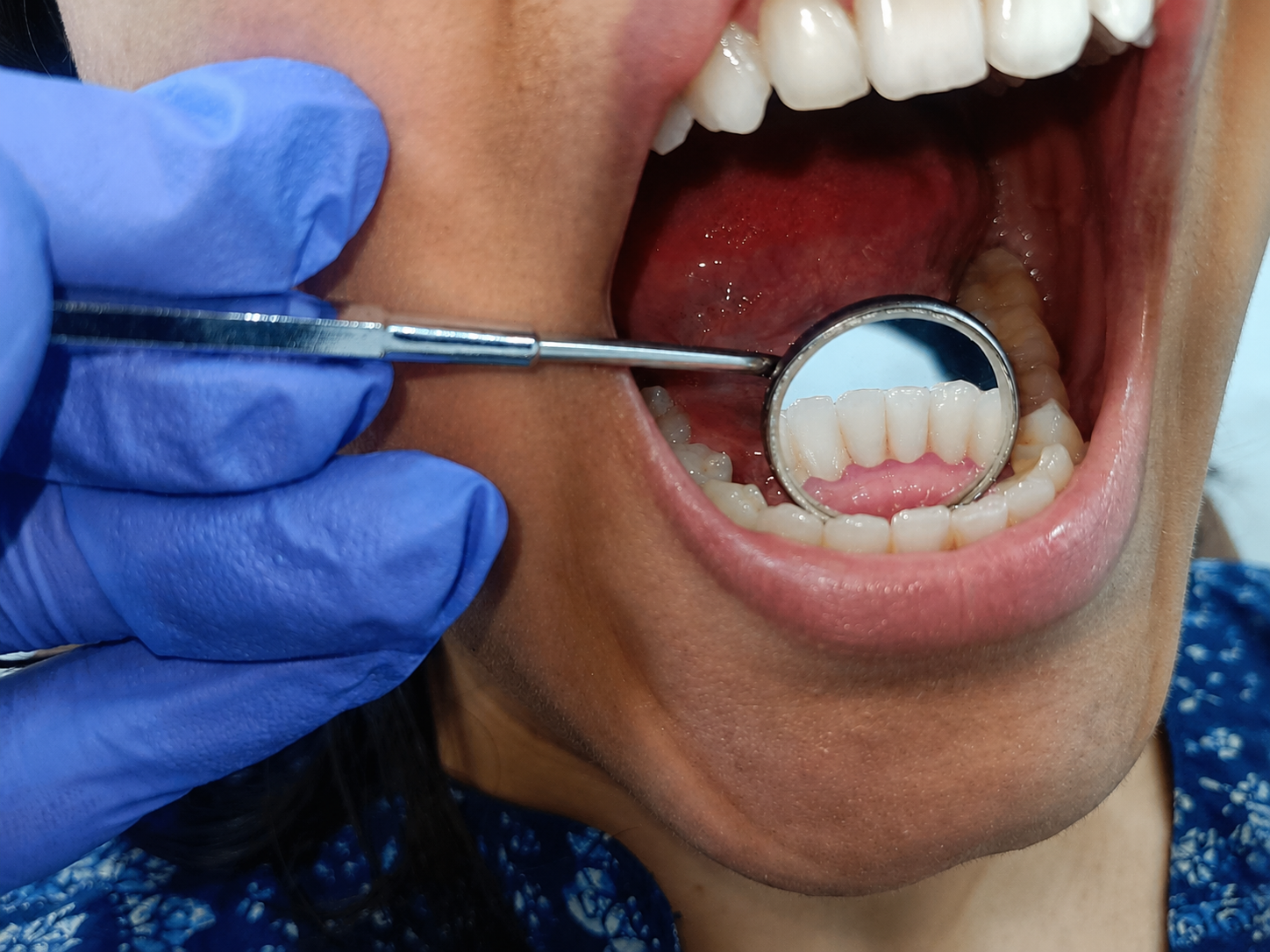 After treatment