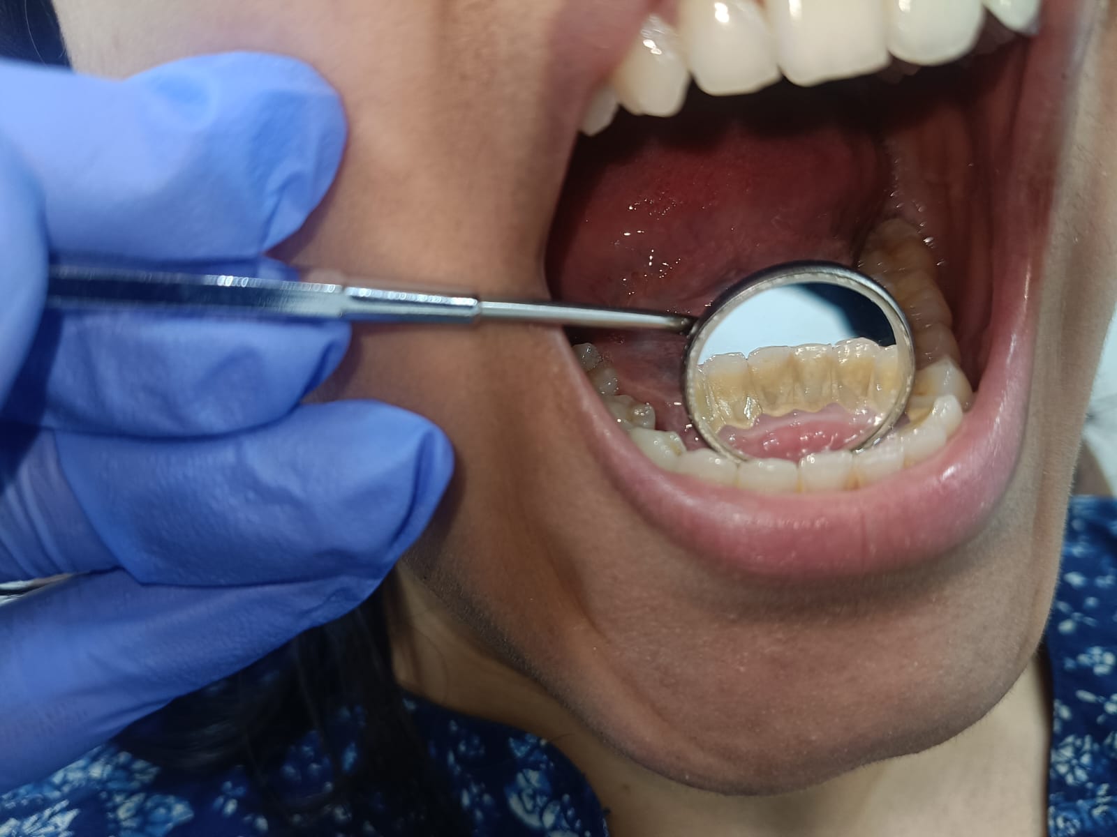 Before treatment